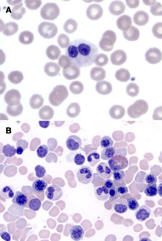 A 49-year-old man presented with hepatitis C virus cirrhosis and pancytopenia. Peripheral blood smear revealed 80% of neutrophils with bilobed nuclei and normal granulation (panel A). Bone marrow morphology demonstrated normally maturing trilineage hematopoiesis without dysplasia or ringed sideroblasts. Bilobed neutrophils were frequently seen (panel B). Flow cytometry, cytogenetics, and chromosomal genomic array testing did not demonstrate a clonal myeloid stem cell disorder. / The Pelger-Huët anomaly is characterized by neutrophils with hypolobated nuclei, including bilobed forms connected by a thin chromatin filament. Congenital Pelger-Huët anomaly is a benign condition associated with autosomal dominant inheritance of mutations in the lamin B–receptor gene and with 55% to 95% of circulating neutrophils exhibiting classic dysmorphology. Lamins create a structural link between chromatin and the internal nuclear membrane, thereby influencing nuclear shape. Acquired or pseudo Pelger-Huët can be associated with myelodysplastic syndrome, acute myeloid leukemia, chronic myeloid leukemia, and leukemoid reactions, or can be drug-induced. In these conditions, nuclear bilobation is generally asymmetric and is present in roughly 25% (clonal disorders) to 50% (drug-induced) of granulocytes. An additional distinguishing feature is chromatin clumping in multiple hematopoietic cells in the congenital form that is present only in granulocytes in the acquired anomaly. Importantly, cytopenias are not associated with congenital Pelger-Huët anomaly and likely reflect underlying hepatitis C virus cirrhosis in this case.