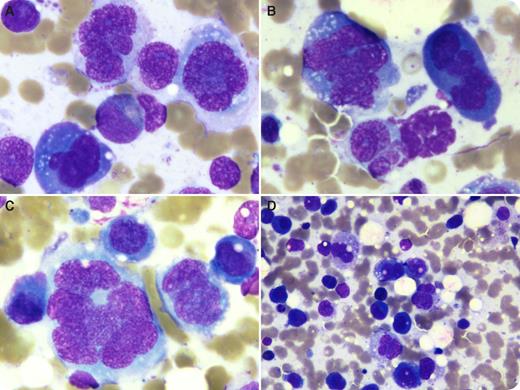 A 60-year-old woman with a 1-year history of lower back pain presented with recent-onset altered sensorium. Clinical examination and neuroimaging did not show any focal neurologic lesions. She had severe anemia (hemoglobin 68 g/L) and mild leukocytosis with 8% circulating multinucleate cells in the peripheral blood. The bone marrow aspirate showed a large number of bizarre, atypical cells with binucleation, multinucleation, and abnormal nuclear lobation (panels A-C; original magnification ×100, May-Grünwald-Giemsa stain). The cytoplasm was basophilic to amphophilic and contained numerous vacuoles in some cells, resembling metastatic, poorly differentiated carcinoma (panel D; original magnification ×20, May-Grünwald-Giemsa stain). Plasma cells were present in adjacent fields. Flow cytometry showed moderate expression of CD38, CD56, and cytoplasmic κ in these cells. Biochemical investigations showed elevated urea and creatinine levels and reversal of the albumin:globulin ratio. Serum protein electrophoresis showed a monoclonal “M” band (3.32 g/dL) that was immunoglobulin G, κ on immunofixation. Magnetic resonance imaging of the spine showed lytic lesions involving multiple vertebrae. / Based on the clinical, biochemical, and radiologic parameters, and combined with the morphology and flow cytometry findings, a diagnosis of anaplastic plasma cell myeloma was made. This case demonstrates the unusual anaplastic morphology of plasma cell myeloma, which can lead to difficulties in morphologic diagnosis.