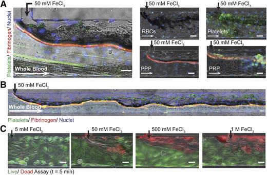 Figure 2. Endothelialized microfluidics. (A) Aggregates form in endothelialized microfluidics infused with 50 mM FeCl3 and whole blood, washed RBCs, washed platelets, PPP, and PRP. Endothelial cells (blue: Hoescht), platelets (green: CD41), fibrinogen (red). (B) Aggregate formation over the length of the microchannel when whole blood is exposed to 50 mM FeCl3. (C) Endothelial cell viability is concentration dependent with increasing cell death at higher concentrations; left to right: 5 mM, 50 mM, 500 mM, 1 M (green/live: calcien, red/dead: propidium iodide). All scale bars represent 50 μm; N = 5.