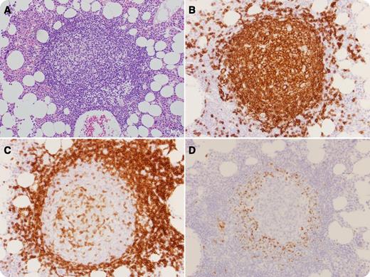 A 45-year-old male presented to his primary care physician with epiphora. Examination identified bilateral conjunctival masses comprising CD20+ B lymphocytes expressing CD5, BCL2, and cyclin D1. A diagnosis of mantle cell lymphoma was rendered. Staging positron emission tomography scans revealed numerous extraocular sites of involvement. Bone marrow biopsy was normocellular with unremarkable flow cytometric immunophenotyping; however, a single lymphoid aggregate was noticed (panel A). Although it appeared to be benign, immunostaining for CD3, CD20, and cyclin D1 was performed, displaying retained immunoarchitecture for CD20 (panel B) and CD3 (panel C). Cyclin D1 highlighted a small subset of B cells within the mantle zone (panel D), indicating low-level involvement by lymphoma. This peculiar pattern of cyclin D1 positivity, in which cyclin D1–positive cells encircled follicles, is characteristic of an early or in situ mantle cell lymphoma. / In situ mantle cell lymphoma is rare and exhibits cyclin D1 positivity within the innermost mantle zone B lymphocytes, often partially encircling follicles. In contrast, full encircling of follicles by cyclin D1–positive cells has been proposed to indicate early involvement by mantle cell lymphoma. To the best of our knowledge, this pattern has not been reported in the marrow. This morphologic observation in a patient with overt mantle cell lymphoma likely represents early homing of the primary lymphoma to the marrow.