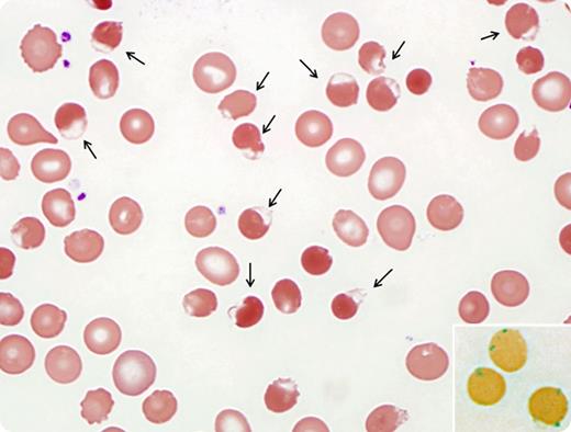 A 58-year-old male with refractory chronic lymphocytic leukemia presented for clinical trial. Prior to treatment, he received rasburicase to prevent tumor lysis syndrome. Within 24 hours, the patient developed an acute hemolysis. The blood smear showed numerous abnormal red blood cells (RBCs) characterized by membranous defects (bite cells) or submembranous blisterlike structures (blister cells). Bite and blister cells are the morphologic hallmark of Heinz body hemolytic anemia (HBHA). Heinz bodies are invisible in a Giemsa-stained smear, but they can be highlighted by supravital staining as 1- to 3-μm inclusions in RBCs (inset). HBHA in this patient is likely secondary to rasburicase, given that he had intermediate glucose-6-phosphate dehydrogenase (G6PD) on screening and resolution of hemolysis after discontinuing rasburicase. / Various oxidant drugs such as dapsone, primaquine, methylene blue, and rasburicase may induce HBHA in individuals susceptible to oxidant stress. Rasburicase is a recombinant urate oxidase that promotes uric acid degradation to a more water-soluble compound; it is contraindicated in patients with G6PD deficiency because of the hemolytic potential of an oxidative byproduct of uric acid breakdown. It is important to recognize the morphologic features of HBHA in blood smears because the bite and blister cells may serve as the initial alert of HBHA.