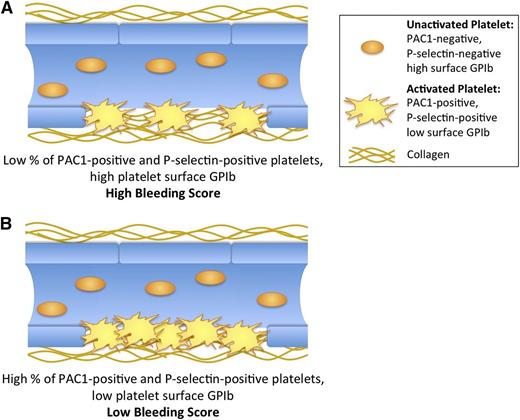 Figure 4. Cartoon representation of platelet activation markers associated with bleeding score independent of platelet count in ITP patients. (A) Patients with high bleeding scores, where low concentration TRAP yields a low percentage of PAC1- and P-selectin–positive platelets. (B) Patients with low bleeding scores, where low concentration TRAP yields a high percentage of PAC1- and P-selectin–positive platelets. (A-B) thus represent patients with different bleeding tendencies despite an equal number of circulating platelets.