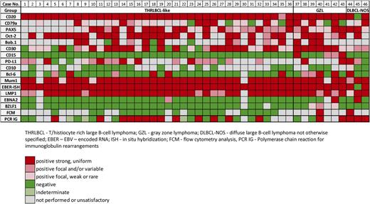 Immunophenotype, EBER-ISH, and B-cell clonality by flow cytometry and PCR in EBV+ LBCL in young patients