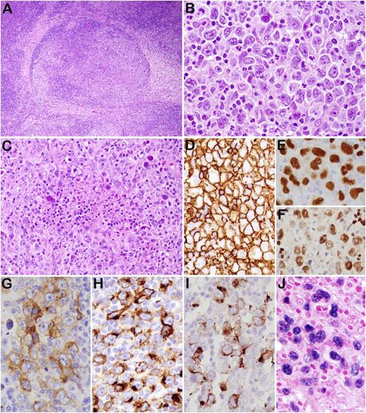 Figure 2. GZL (case 43). (A) The lymph node architecture is altered by nodular proliferation divided by collagen bands. (B) Sheets of large cells resembling HRS cells and variants—admixed with small lymphocytes, eosinophils, and granulocytes—are identified. (C) Foci of necrosis are present. The tumor cells are strongly and uniformly positive for CD20 (D), PAX5 (E), and Oct-2 (F). They are also positive for CD30 (G), CD15 (H), LMP1 (I), and EBER (J). Original magnifications: ×40 (A); ×200 (C), and ×400 (B,D-J).