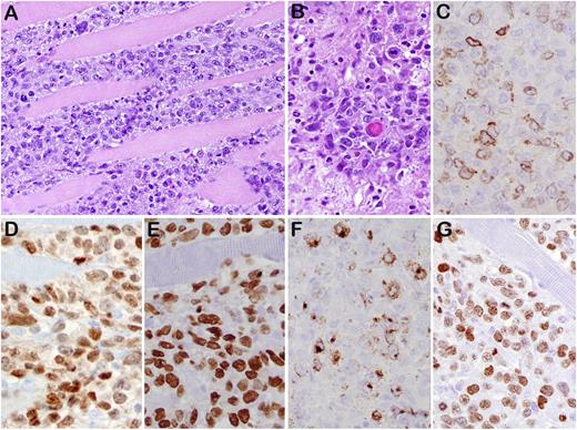 Figure 3. DLBCL-NOS (case 45). (A) Diffuse lymphoid proliferation of medium to large cells that dissects the skeletal muscle of chest wall. (B) Mitotic figures were readily seen. The tumor cells are positive for CD79a focal (C), PAX5 strong (D), MUM1 (E), LMP1 (F), and EBNA2 (G). This was 1 of 3 cases that expressed a latency III phenotype. Original magnifications: ×200 (A) and ×400 (B-G).