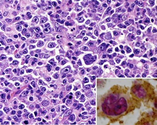 Lymph node biopsy from a patient with EBV+ LBCL. The cells are pleomorphic including the presence of Hodgkin-like cells. Inset, the neoplastic B cells are positive for PAX5 (red nuclear stain) and strongly express PD-L1 (brown), which may inhibit the host antitumor response. Hematoxylin and eosin, original magnification ×250; inset, double immunostain for Pax5 (red) and PD-L1 (brown).