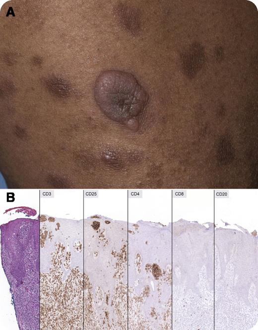A 36-year-old Jamaican woman presented with flat erythematous and pruritic lesions on her thighs. Physical examination revealed well-demarcated hyperpigmented discoid lesions on her hands and inner thighs and nodular lesions on her lower legs, as shown in panel A. Skin biopsy demonstrated dermal and epidermal infiltration by atypical lymphoid cells forming Pautrier-like microabscesses. Panel B (sequential serial sections) illustrates positive staining for CD3, CD4, and CD25 (strong) in the neoplastic cells; CD8, CD20, and FOXP3 (not shown) were negative. Polymerase chain reaction studies were positive for clonal T-cell receptor γ gene rearrangement and human T-cell lymphotropic virus 1 (HTLV-1) viral DNA, with positive HTLV-1 serology. Bone marrow and peripheral blood were negative for abnormal cells. Baseline lactate dehydrogenase was mildly elevated (303 U/L), and serum calcium was normal. Staging was negative for visceral, nodal, or bony disease. The findings are diagnostic of adult T-cell leukemia/lymphoma (ATL) with cutaneous involvement. / Cutaneous involvement is seen in more than 50% of patients with ATL. The typical immunophenotype is CD3+CD4+CD25+. FOXP3 is expressed in a subset of patients. Strong expression for CD25 (α chain of the interleukin-2 receptor) is helpful in the differential diagnosis with mycosis fungoides, as is the lack of an inflammatory background. Positive serology for HTLV-1 is supportive, but identification of HTLV-1 DNA is more specific.