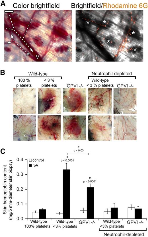 Figure 1. Neutrophils are the cause of skin bleeding in thrombocytopenic and GPVI−/− mice during the cutaneous rpA reaction. (A) Intravital microscopy imaging of the cutaneous rpA reaction in a thrombocytopenic mouse injected with rhodamine-6G for staining of leukocytes. Bright-field color image showing that bleeding originated from capillaries and postcapillary venules (left). Arterioles (A) and venules (V) were identified by whether they collected or distributed blood from/to lower caliber vessels. Merged image of bright-field and corresponding rhodamine-6G image showing that bleeding occurred from vessels in which leukocytes accumulated (white asterisks) (right). Scale bar, 200 µm. (B) Representative images of the inner layer of the skin subjected to the rpA reaction from control (100% platelets), thrombocytopenic (<3% platelets), GPVI−/− mice, and thrombocytopenic and GPVI−/− that were immunodepleted for neutrophils prior to the induction of the rpA reaction. Images were taken 4 hours after inducing the rpA reaction. (C) Hemoglobin content in skin biopsy specimens from control and rpA reaction areas from the various groups of mice, as indicated. n = 6-18 mice per group. # indicates a statistically significant increase (P < .05) in hemoglobin content as compared with control spots from control wild-type mice.