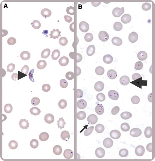 A 17-year-old teenager presented with fever and jaundice for 1 week that was preceded by 3 weeks of abdominal pain and malaise. The patient was born in The Gambia but had lived in the United States for most of his life except for the last 2 years, when he had returned to The Gambia. He was in the United States for 10 days at time of admission. Physical examination revealed depressed sensorium with a Glasgow Coma Scale of 15. He was afebrile and hemodynamically stable on admission but developed hypotension refractory to intravenous fluids, leading to transfer to the intensive care unit within 12 hours of presentation. A complete blood count showed a hemoglobin level of 6.1 g/dL with a nadir of 5.8 g/dL. The peripheral blood smear was diagnostic for Plasmodium falciparum, showing numerous intracellular parasites, with a calculated 28% parasitemia. There were crescent-shaped gametocytes (panel A, arrowhead), ring forms with split chromatin giving the typical “headphone” appearance (panel B, thick arrow), erythrocytes infected with multiple parasites, and appliqué forms (rings appearing on the periphery of the erythrocyte) (panel B, thin arrow). / He recovered after a transfusion of 4 units of packed red blood cells and treatment with quinidine and doxycycline, both administered intravenously.