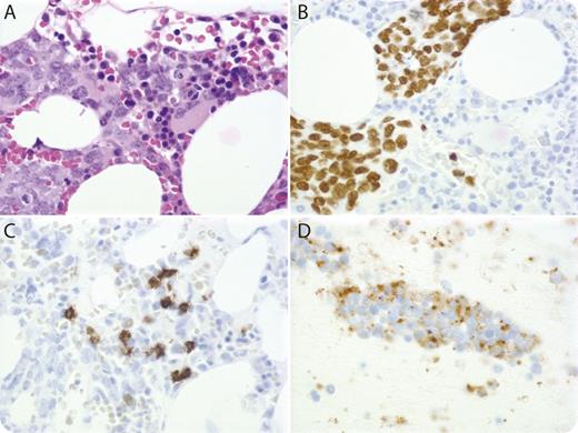 A 77-year-old woman with a remote smoking history presented with progressive dyspnea, chest discomfort, and hypoxia. Computed tomography showed extensive mediastinal, hilar, and perisplenic adenopathy. Her laboratory work was notable for thrombocytopenia (platelets = 77 K/μL), mild anemia (hemoglobin = 11.2 g/dL), high lactate dehydrogenase (4325 IU/L), and hyperuricemia (11.2 mg/dL). Because of a concern for high-grade lymphoma, the patient underwent bone marrow (BM) biopsy, which showed extensive infiltration by atypical cells (panel A) immunoreactive for thyroid transcription factor-1 (panel B) and chromogranin (weakly), and nonimmunoreactive for CD20 (panel C), CD3, CD34, and CD117. Flow cytometric analysis revealed a small population of CD20(dim)CD5+CD23+ B cells, positive for clonal immunoglobulin heavy chain gene rearrangement by polymerase chain reaction, suggestive of monoclonal B-cell lymphocytosis. Fine needle aspiration biopsy of a mediastinal lymph node confirmed the diagnosis of small cell lung cancer (SCLC) (panel D; chromogranin immunostain). The patient started chemotherapy with carboplatin and etoposide but died from tumor lysis syndrome. / BM involvement is common in SCLC, but because of a lack of independent prognostic value, it is not a routine part of SCLC staging. On the other hand, SCLC can mimic high-grade lymphoma, especially when it presents with extensive nodal and/or BM involvement without an identifiable primary lesion, in which cases, BM biopsy can be valuable for differential diagnosis.