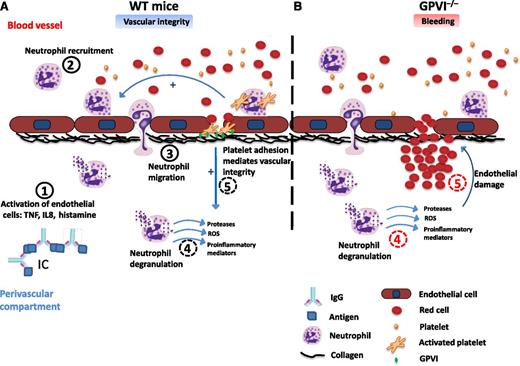 Proposed mechanism for platelet GPVI in maintaining vascular integrity during immune-complex–mediated inflammation. (A) Proposed mechanism for the role of platelets in wild-type (WT) mice. (A1) Immune complex formation in the perivascular compartment induces endothelial cells activation mainly through the release of proinflammatory cytokines and histamine from activated immune cells. (A2) Neutrophils are recruited to the activated endothelium, adhere, and transmigrate to the inflamed tissue. (A3,4) Platelets, including activation of GPVI, enhance neutrophil recruitment, infiltration, degranulation, and oxidative stress. (A5) Single platelets adhere to the subendothelium and seal the neutrophil-mediated vascular damage. (B) Proposed mechanism for the role of platelets in GPVI−/− mice. (B4) Neutrophil recruitment, infiltration, and degranulation in the inflamed tissue induce vascular damage, although this is partly reduced by the absence of GPVI. (B5) Platelets are not able to adhere and seal neutrophil-mediated vascular damage in the absence of GPVI, thereby increasing blood leakage and local hemorrhage. IC, immune complex; ROS, reactive oxygen species; TNF, tumor necrosis factor; IL8, interleukin-8; IgG, immunoglobulin G.