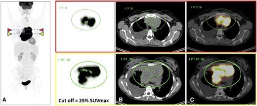 FDG-PET/CT images from a 25-year-old woman with PMBCL who progressed and died under treatment with R-MACOP-B. (A) FDG-PET images (maximum intensity projection view and transverse slices at 2 different levels) demonstrate high FDG uptake in a bulky mediastinal mass; the green circle defines a volume of interest where the MTV is automatically segmented with a 25% SUVmax threshold. MTV limits are displayed in green around the mediastinal tumor. SUVmax = 29; TLG = 6706, falling in the high-risk category. (B) CT with the projections of the MTV contours segmented on FDG-PET. (C) Fused FDG-PET and CT images. Courtesy of Dr Luca Ceriani.