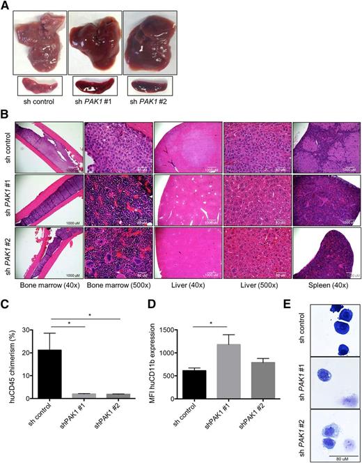 Figure 5. PAK1 reduction inhibits AML progression in vivo. (A) Gross liver and spleen images 46 days after transplantation of 3 × 105 sh control, shPAK1#1, or shPAK1#2 THP-1 cells (4 animals per group per experiment; n = 2). (B) Hematoxylin and eosin (H&E) staining of femur, liver, and spleen sections of transplanted animals. (C) Chimerism of human THP-1 cells in the liver quantified by flow cytometry for cells expressing human CD45. Data represent the mean ± standard deviation. (D) CD11b expression levels on the surface of human CD45 expressing THP-1 cells isolated from the livers of animals transplanted with THP-1 cells expressing the control shRNA lentivirus or 1 of 2 PAK1 targeting sequences. (E) Cytospin preparations and Wright-Giemsa staining of THP-1 cells FACS sorted from the livers of transplanted animals. The few remaining cells that could be isolated from animals receiving PAK1 knockdown cells exhibit signs of myelomonocytic differentiation. *P < .05 for all experiments.