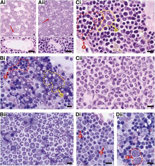 Figure 1. Representative histology of normal and aberrant hematopoiesis in mice. Images shown are either from wild-type C57Bl/6 mice (indicated by i) or from C57Bl/6 Crebbp+/− mice with MDS/MPN (indicated by ii), as examples of abnormal hematopoietic histology. (A) Compared with (Ai) H&E-stained wild-type BM, (Aii) hypercellular Crebbp+/− BM demonstrates marked compression and flattening of sinusoidal channels (red arrows and a high magnification of the indicated sinusoidal channels at the bottom) in the medullary cavity. (B-C) Giemsa-stained BM touch preparation and tissue section, respectively, show a myeloid:erythroid (M:E) ratio close to 1.5:1 in (Bi-Ci) wild-type, whereas (Bii-Cii) Crebbp+/− BM is dominated by mature segmented granulocytes). The yellow dashed line demarks areas of myelopoiesis (M); the red dashed line areas of erythropoiesis (E). (D) A Giemsa-stained wild-type spleen touch preparation contains mostly (Di) mature lymphocytes and occasional erythroid precursors (Di, arrows). In contrast, (Dii) an enlarged Crebbp+/− spleen shows extramedullary hematopoiesis with erythroid precursors (red dashed lines) and scattered granulocyte precursors with a few interspersed lymphocytes. All images in this review were produced at room temperature, using an Olympus BX51 microscope and a DP72 camera (Olympus, Center Valley, PA). Cellsens digital imaging software v.1.3 (www.olympusamerica.com) was used to capture the images. Magnification: (top panels of A) ×10; (B) ×40; and (bottom panels of A,C,D) ×60. Scale bars, 10 μm.
