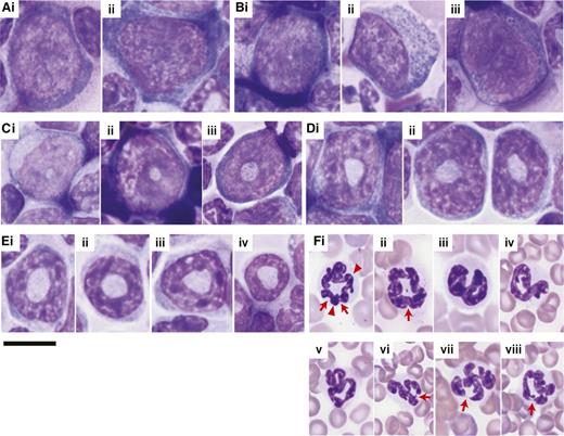 Figure 2. Morphologic characteristics of the different stages of granulocytic maturation in wild-type mice. Images are of Giemsa-stained (A-E) BM touch preparations and (F) PB smears. The series of pictures from A to F represent the granulocytic differentiation process from the most immature precursors to the most mature form. (Ai-Aii) Myeloblasts have oval nuclei with fine chromatin and distinct nucleoli. Some (Bi-Bii) promyelocytes start to show a small, central clearing in the nucleus that indicates the beginning of the maturation process. The granules in murine promyelocytes are difficult to discern in comparison with their human counterpart. The nuclear clearing enlarges with increasing differentiation, transforming the nucleus to ring-like structures in (Ci-Ciii) myelocytes, (Di-Dii) metamyelocytes, and (Ei-Eiv) band cells, where the string-like form is thinnest. The nuclei of mature neutrophils are most often (Fi-Fii) curled/ringed or (Fiii-Fv) twisted but can also be (Fvi-Fviii) fully segmented. Arrows point to filaments of chromatin separating nuclear segments; arrowheads point to nuclear folds. Of note, myelocytes and metamyelocytes may be difficult to distinguish from immature monocytes because all may have ring-shaped nuclei and a pale blue cytoplasm. Magnification: ×60. Scale bars, 10 μm for all images.
