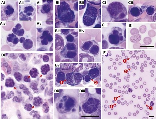 Figure 3. Dysplasia in the erythroid lineage. Representative images are of (A-C,Dii-Diii) Giemsa-stained BM touch preparations, (Di) H&E-stained bone sections, and (E-F) Giemsa-stained PB smears obtained from wild-type recipients transplanted with Crebbp+/− LSKs or unfractionated BM cells. (A) Erythroid precursors with abnormal nuclear contours (lobulation). (Bi-Biv) Binucleated erythroid precursors. (Bv) Coexistence of (1) a binucleated erythroid precursor and (2) an erythroid precursor with nuclear budding. (Ci-Ciii) Erythroid precursors with nuclear budding. (Di-Diii) Karyorrhexis in erythroid precursors. (E) Basophilic stippling in peripheral red blood cells. (F) Anisopoikilocytosis, (1) microcytes, (2) macrocytes, (3) target cells, (4) tear-drop cells, and (5) red blood cell fragments. Magnification: (A-E) ×60 and (F) ×20. Scale bars, 10 μm; scale bar provided in Diii serves all images included in A to D.