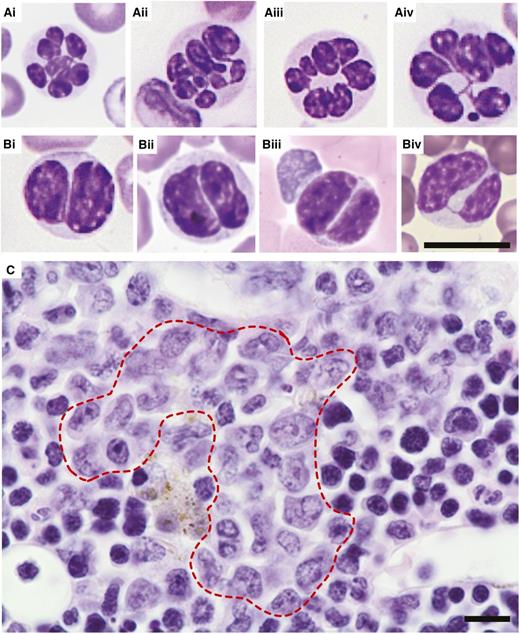 Figure 4. Dysplasia in the myeloid lineage. Representative images of (A-B) Giemsa-stained PB smears and (C) H&E-stained BM sections obtained from wild-type recipients transplanted with Crebbp+/− LSKs or unfractionated BM cells. (A) Hypersegmented granulocytes. (B) Pseudo-Pelger-Huet anomalies in bilobed cells most consistent with neutrophils. (C) Atypical localization of immature precursors (red dashed line; ie, clusters of myeloid precursors present in the intertrabecular area, rather than adjacent to trabeculae or surrounding endothelial cells as is the case in wild-type hematopoiesis). Magnification: ×60. Scale bars, 10 μm; scale bar provided in Biv serves all images included in A and B.