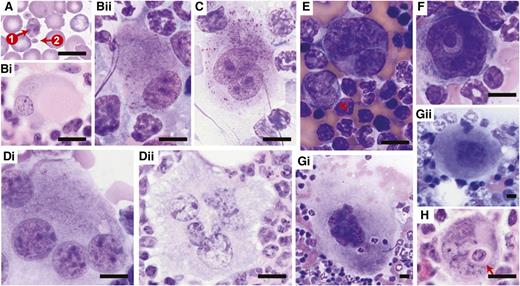 Figure 5. Dysplasia in the megakaryocytic lineage. Representative images are of (A) Giemsa-stained peripheral blood smears, Giemsa-stained (Bii,C,Di,E,F,Gi,Gii) BM touch preparations, and (Bi,Dii,H) H&E-stained bone sections obtained from wild-type recipients transplanted with Crebbp+/− LSKs or unfractionated BM cells. (A) Giant platelet (arrow 1) in comparison with normal-sized platelet (arrow 2). (Bi-Bii) Megakaryocytes with eccentric, monolobated nuclei. (C) Binucleated megakaryocyte. (Di-Dii) Multinucleated megakaryocytes. (E) Micro-megakaryocyte (arrow). (F) Megakaryocyte with a ring-shaped nucleus. (Gi) A giant megakaryocyte. The size of this particular one is 10 804.9 μm2, in comparison with (Gii) a wild-type megakaryocyte of 1843.7 μm2 in size. (H) Emperipolesis of neutrophils (arrow) within megakaryocyte. Magnification: ×60. Scale bars, 10 μm. Of note, bone sections sliced at any particular level merely provide a 2-dimensional representation of the 3-dimensional BM tissue. The appearance of mono/hypolobulation may result from superficial sectioning of a deeper, well-lobulated megakaryocyte. Similarly, what seems to be multiple nuclei may actually represent different lobes of the same nucleus that are connected to each other at a deeper level tissue section. Therefore, although bone sections provide a good approach for preserving the architecture of BM, they can convey a misleading impression of cell morphology, and thus caution needs to be taken when evaluating the nuclear lobes of megakaryocytes. A more accurate evaluation can be made using BM touch preparations where complete cells are attached to the slides.