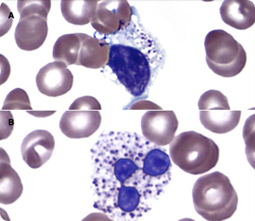 A 35-year-old woman with a history of systemic lupus erythematosus presented with 3 weeks of cough and nasal congestion. She was presumed to have an upper respiratory tract infection. Blood counts showed leukopenia (white blood cell count, 1.8 × 109/L) with absolute neutropenia (0.25 × 109/L). A peripheral blood smear showed granulocytes and lymphocytes with cytoplasmic vacuoles of variable size. Within some vacuoles were dense, basophilic, round to ovoid granules (panel A, lymphocyte; panel B, neutrophil). Review of prior laboratory data reported abnormal granulation within lymphocytes and granulocytes for ∼14 months. Evaluation of the patient’s medication history revealed that she was started on chloroquine therapy ∼16 months prior. Follow-up identified no specific infectious etiology for the patient’s symptoms and the neutropenia resolved without intervention. / Morphologic changes have been described in leukocytes in patients undergoing chloroquine therapy. Changes seen may include an increase in cytoplasmic vacuoles, some containing irregular inclusions. One theoretical mechanism to explain this phenomenon includes an inhibitory effect of chloroquine on enzymes involved in degradation of lysosomal constituents. Such morphologic changes should be distinguished from intracellular organisms and signs of leukocyte activation (neutrophil toxic granulation, large granular lymphocytes). Careful review of clinical data and medication history may facilitate recognition of this phenomenon.
