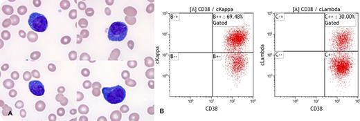 A 57-year-old man presented with a history of peripheral T-cell lymphoma that was diagnosed 2 years previously and that recurred 1 year later after 6 cycles of combination therapy with cyclophosphamide, daunorubicin, vincristine, and prednisone. A complete blood count showed an elevated white blood cell count (1.53 × 103/μL), normocytic anemia, and thrombocytopenia. A comprehensive metabolic panel showed an increase in total protein (9.7 g/dL) and decreased albumin level (3.3 g/dL). Serum immunoglobulin G level was elevated as well (5310 mg/dL). A peripheral blood smear was reviewed, which showed prominent rouleau formation with circulating plasma cells and plasmacytoid lymphocytes (>20% of the white blood cells). These findings were indicative of a plasma cell leukemia (panel A). However, flow cytometry analysis showed the plasma cells were positive for CD38 (bright) and CD138 and were polytypic with cytoplasmic κ and λ (ratio 2.3:1) (panel B). / Polytypic plasmacytosis in the peripheral blood has been seen in patients with sepsis, viral infections, autoimmune conditions, and, less commonly, peripheral T-cell lymphomas such as angioimmunoblastic T-cell lymphoma. The latter may be caused by increased cytokine release, such as interleukin-6. This phenomenon is uncommon but can mimic plasma cell leukemia with rouleau formation.