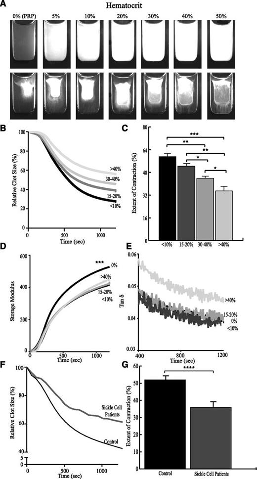 Figure 5. Effects of RBCs on clot contraction and dynamic viscoelastic properties. RBCs were resuspended in mixtures of PRP and autologous PFP to vary the volume fraction of RBCs from <10% to >40% while keeping the platelet count and fibrinogen concentration constant. (A) Images of the clots before (upper row) and after (bottom row) 30-minute contraction induced by thrombin and CaCl2. Plots show the effects of RBCs on (B) the kinetics of contraction, (C) the final extent of contraction, (D) the elastic properties of the contracting clot (storage modulus, G′), and (E) the ratio of viscous to elastic properties (tan δ = G″/G′). The lower plots show the (F) averaged kinetics of clot contraction and the (G) average final extent of contraction in the whole blood of SCD patients (n = 3) vs whole blood from healthy controls (n = 51). *P < .05; **P < .01; ***P < .001; ****P < .0001.