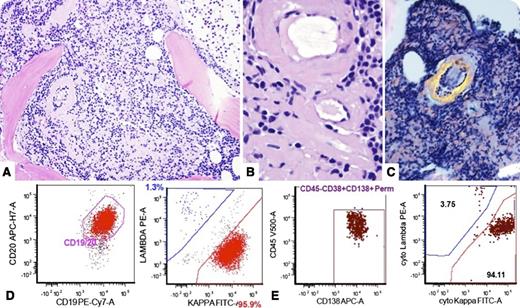 A 66-year-old woman developed increasing fatigue over 6 months. Laboratory studies showed anemia (hemoglobin 10.2 g/dL), elevated serum immunoglobulin (Ig)M (1580 mg/dL), and IgM κ M-protein. Imaging studies showed an enlarged heart, thickening of the esophagus, and slightly enlarged mediastinal lymph nodes (1.4 cm) without fluorodeoxyglucose-avid skeletal lesions. Serum viscosity was not increased. Bone marrow biopsy showed extensive interstitial and vascular amyloid deposition (panels A-B) associated with a B-cell infiltrate. Congo-red stain showed apple-green birefringence within amyloid deposits (panel C). Aspirate smears showed a mixture of small lymphocytes, lymphoplasmacytoid lymphocytes, and plasma cells. Flow cytometry immunophenotypic studies showed both κ monoclonal B cells and κ monoclonal plasma cells (panels D and E, respectively). A diagnosis of lymphoplasmacytic lymphoma/Waldenström macroglobulinemia (WM) with systemic amyloidosis was made. Mutational studies were negative for MYD88 (L265P) and positive for CXCR4 (G335S). Liquid chromatography tandem mass spectrometry analysis on Congo-red positive microdissected areas in paraffin-embedded tissue confirmed amyloid light-chain (AL) (κ)-type. An abdominal fat pad biopsy was also positive for amyloid. The patient was started on rituximab, cyclophosphamide, and dexamethasone therapy. / This case highlights that systemic amyloidosis is an unusual presenting complication of WM. Amyloidosis in WM is rare (3%), is generally of the systemic AL type, and is associated with multiorgan involvement and high IgM levels.