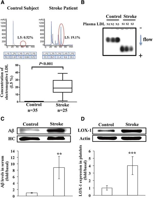 Figure 1. Elevated plasma L5 levels in patients with ischemic stroke. (A) Representative results from FPLC with anion exchange columns showing the distribution of LDL subfractions in a patient with ischemic stroke and a normal control subject. The red circles indicate L5. The L5% is plotted for the control subjects and the ischemic stroke patients. (B) Agarose gel electrophoresis of plasma LDL from 3 normal control subjects (N1, N2, and N3) and from 3 patients with acute ischemic stroke (S1, S2, and S3). The arrow indicates the direction of electron flow. (C) Immunoprecipitation isolation and western blot analysis of Aβ secreted in the serum of control subjects or patients with ischemic stroke (n = 8). (D) Western blot analysis of LOX-1 expression on the platelets of control subjects or patients with ischemic stroke (n = 8). Quantified results are expressed as the mean ± SD; P values were determined by using the Wilcoxon signed-rank test. **P < .01; ***P < .001 vs the control group. HC, heavy chain of IgG antibody; mAU, milliabsorbance units.