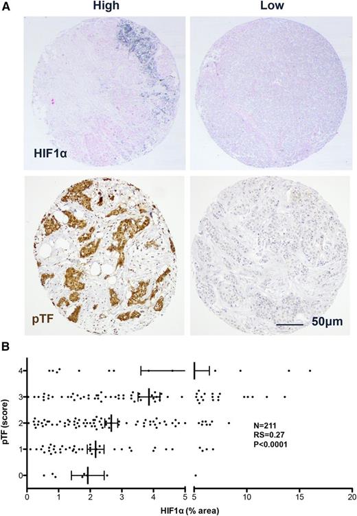Figure 3. Correlation between HIF1α and phosphorylated TF in human breast tumors. (A) Representative images of human breast tumor microarrays stained for HIF1α (black, upper panels) and phosphorylated TF (pTF, brown, lower panels). (B) Scatterplot of HIF1α level vs pTF score in human breast tumor microarrays (n = 211). Spearman’s correlation: RS = 0.27, P < .0001.