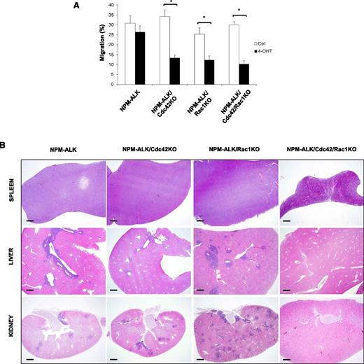 Figure 6. Effects of Cdc42 and Rac1 deletions on in vitro migration and in vivo dissemination of NPM-ALK lymphoma cells. (A) Three independent CreERT2 lymphoma cell lines for each genotype were transduced with a retrovirus expressing Bcl2 to protect cells from apoptosis as in Figure 5. Cdc42 and Rac1 deletions were induced by treatment with 10 nM 4-hydroxytamoxifen for 4 hours. Cell were then seeded into the upper chamber of transwells (0.8 µm pore size) and allowed to migrate toward a gradient of SDF-1α (100 ng/mL) that was plated in the lower chamber for 4 hours in CO2 incubator. Migrated cells in the bottom chamber were counted. The histograms indicate means ± SD from 3 independent cell lines for each genotype using triplicate wells for experimental point. The Student t test was used to calculate statistical significance (*P < .001). (B) Immortalized NPM-ALK lymphoma cell lines with the genotypes as in panel A were inoculated i.v. (5 × 106) in NOD scid γ (NSG) mice. After 15 days, mice were euthanized and all organs were isolated and fixed in formalin solution for H&E staining. Figure shows representative histology of spleen, liver, and kidney. NPM-ALK;CreERT2 (NPM-ALK), NPM-ALK;CreERT2;Cdc42fl/fl;Bcl2 (NPM-ALK/Cdc42KO), NPM-ALK;CreERT2;Rac1fl/fl;Bcl2 (NPM-ALK/Rac1KO), NPM-ALK;CreERT2;Cdc42fl/fl;Rac1fl/fl;Bcl2 (NPM-ALK/Cdc42/Rac1KO). Scale bar, 1 mm.
