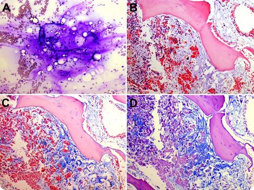 A 16-year-old girl with X-linked hypophosphatemic rickets, anorexia nervosa, and rumination syndrome with severe malnutrition underwent bone marrow examination for leukopenia (2.03 × 109/L), mildly macrocytic anemia (hemoglobin, 106 g/L; mean corpuscular volume, 99.3 fL), and thrombocytopenia (114 × 109/L), which had persisted during refeeding. The bone marrow aspirate smears (panel A; Wright-Giemsa stain) contained stromal elements (amorphous bluish-pink material, capillaries, and nuclei) and occasional hematopoietic cells, most of which were lymphocytes. The trephine biopsy (panel B; hematoxylin and eosin stain) demonstrated a mix of amorphous bluish, finely fibrillar/granular material (in which focal adipocytic atrophy was noted) consistent with gelatinous transformation and foci of multilineage hematopoiesis. Alcian blue (pH 2.5) and Alcian blue-periodic acid-Schiff stains (panels C-D) revealed that the amorphous material was composed of acid mucosubstances. / Gelatinous transformation, also known as serous fat atrophy, is a relatively nonspecific bone marrow finding which has been linked to anorexia nervosa (as in our patient) and cachexia from chronic debilitating illnesses such as infections (AIDS, tuberculosis, leishmaniasis), malignancy (carcinoma, leukemia/lymphoma), lupus, hypothyroidism, renal or heart failure, celiac disease, intestinal lymphangiectasia, and alcoholism and has been found at irradiated sites. Marrow and subcutaneous fat signal abnormalities can also be detected with magnetic resonance imaging.