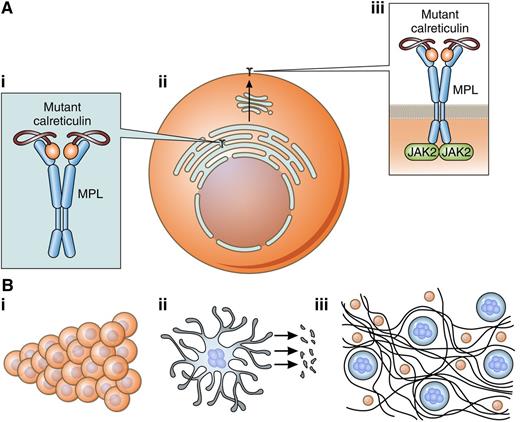 Schematic representation of the molecular pathogenesis of CALR-mutant MPNs based on the findings of the 3 articles of this issue.1-3 (A) TPO-independent activation of the TPO receptor (MPL) by mutant calreticulin in an individual hematopoietic cell. (i) Abnormal physical interaction between mutant calreticulin and TPO receptor within the ER. (ii) MPL coupled with mutant calreticulin is exported on the cell surface through the Golgi apparatus and/or an alternative pathway. (iii) TPO-independent activation of MPL, and in turn dimerization and activation of JAK2. As a chaperone, calreticulin normally assists proper folding of the TPO receptor (MPL) inside the ER. Mutant calreticulin preferentially interacts with MPL, and the mutant-specific domain of the protein is required for this interaction that leads to stable binding. Here, it is assumed that the MPL dimer is already assembled in the ER, but another possibility is that dimerization occurs on the cell surface. It is also uncertain whether both MPL subunits bind mutant calreticulin, or just one of them does; again, both events might take place. The interaction of mutant calreticulin with MPL activates MPL signaling through JAK2. (B) Biological and clinical consequences. (i) Activated MPL-driven clonal expansion of HSCs. (ii) Excessive platelet production by abnormal megakaryocytes: ET. (iii) Bone marrow reticulin formation: progression from ET to myelofibrosis. Most patients with a CALR-mutant MPN have fully clonal hematopoiesis, indicating that the founding mutation drives clonal expansion at the HSC level. Under normal conditions, adult HSCs are TPO-dependent for their survival and maintenance in the osteoblastic niche10,11; thus, mutant calreticulin-induced abnormal MPL signaling is likely responsible for clonal expansion of HSCs carrying a CALR mutation. At the hematopoietic precursor level, the only cells in which MPL signaling is effective are megakaryocytes, and therefore MPL-signaling activation leads to overproduction of platelets. Mutant calreticulin-expressing megakaryocytes also contribute to bone marrow fibrosis, and in the long-term this process leads to a transition from ET to myelofibrosis. Professional illustration by Patrick Lane, ScEYEnce Studios.