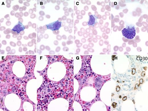 A 90-year-old woman presented with fevers and pancytopenia. The peripheral blood smear (see panels A-D) showed rare large atypical cells with convoluted nuclei and visible nucleoli. A few stripped multilobulated nuclei were present at the feathered edge. Bone marrow biopsy showed large atypical cells ranging from hallmark cells to larger pleomorphic cells (see panels E-H). These expressed CD3, CD4, CD7 (dim), CD30 (membranous and Golgi), TIA-1, granzyme B, and perforin. They were negative for CD8, CD20, PAX5, and ALK1. The patient entered hospice and died a week later. / Large pleomorphic lymphoma cells are rarely seen in the peripheral blood even with bone marrow involvement. The differential diagnosis in this case includes systemic involvement by a primary cutaneous CD30+ lymphoproliferative disorder, peripheral T-cell lymphoma NOS, ALK+ anaplastic large cell lymphoma (ALCL), and ALK− ALCL. The latter was favored given the clinical features and immunophenotype. A small-cell variant of ALK+ ALCL can sometimes present with leukemic involvement, but this morphology is not accepted for ALK− ALCL. Due to the lack of potential clinical impact in this patient, fluorescence in situ hybridization for DUSP22 and TP63 rearrangements was not pursued. However, the lymphoma cells do not have the typical morphology of DUSP22 rearranged cases, and immunohistochemistry for p63 was negative.