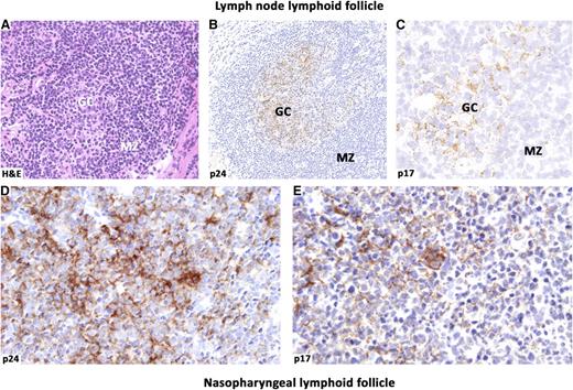 Figure 2. HIV-released proteins within lymphoid follicles. Persistence of HIV-encoded proteins in the GC of lymphoid follicles in patients under cART. Histological sections from lymph node (A-C) and nasopharynx (D-E) were immunolabeled for the capsid p24 (B and D) and the matrix p17 (C,E) proteins. HIV p24 and p17 deposited in the GCs show similar distribution in the biopsy sites and display a dendritic pattern. Matrix p17 accumulates and persists within lymphoid tissues of HIV-infected patients in both lymph nodes and extranodal sites, where this protein may exert its pathogenic effects on B cells. Images were acquired with the Olympus Dot.Slide Virtual microscopy system, using an Olympus BX51 microscopy equipped with PLAN APO 2×/0.08 and UPLAN SApo 40×/0.95 objectives. Images were assembled using Adobe Photoshop 6 (Adobe Systems, San Jose, CA).