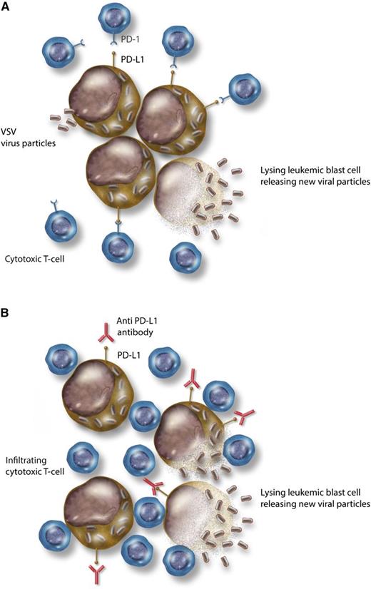 Combining immune checkpoint blockade with an oncolytic virus. (A) VSV infecting leukemic blasts, replicating within them, and causing cell lysis. PD-L1, expressed on leukemic blasts, interacts with PD-1 on cytotoxic T lymphocytes and suppresses their effector function. (B) Addition of anti–PD-L1 antibody disrupts the immune checkpoint interaction and releases the T-cell inhibition. Effector T lymphocytes are now able to infiltrate and potentiate an immune response against the virally infected blasts, increasing cell kill. Professional illustration by Somersault18:24.
