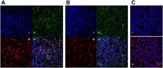 Figure 2. MDSCs in the spleens of control patients and patients with ITP. CD11b+CD33+ double-positive cells in spleen sections were visualized by immunofluorescence. Nuclei were counterstained with DAPI. Representative staining of (Ai, Bi) nuclei, (Aii, Bii) CD33, (Aiii, Biii) CD11b, and (Aiv, Biv) merged images of control (A) and ITP (B) spleens. CD11b+CD33+ cells were counted per merged view. The expression (mean fluorescence intensity; OD = IOD/area) of iNOS in splenic MDSCs from control patients (Ci) and patients with ITP (Cii). Original magnification, ×400 (spleen). Scale bars, 20 μm.