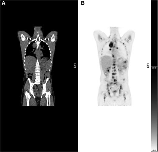 Figure 2. Example of upstaging by PET-CT. (A) CT and (B) PET coronal images show a case upstaged by PET-CT. Nodal and splenic involvement was reported on CT and interpreted as stage 3. The PET scan showed multifocal uptake in bone marrow upstaging to stage 4.