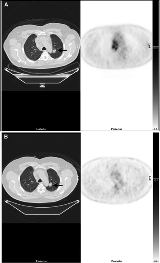 Figure 3. Example of downstaging by PET-CT. (Left) CT and (right) PET axial images show a case downstaged by PET-CT. (A) There was nodal disease in the mediastinum and a 22-mm lung nodule in the left lung (arrow), reported on CT as stage 4. The PET scan showed high uptake in lymph nodes but no FDG uptake in the lung nodule, suggesting the nodule was unlikely to be due to lymphoma interpreted as stage 2. (B) After treatment, there was resolution of uptake in lymph nodes but the lung nodule (arrow) was unchanged.
