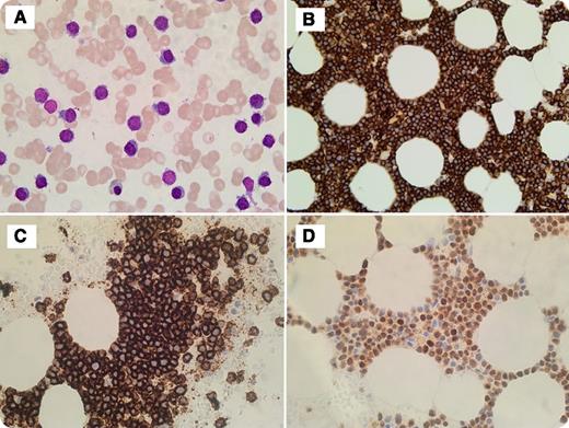 A 78-year-old man with a previous history of prostate cancer and cholecystectomy presented to the clinic with increased fatigue and shortness of breath upon exertion. Blood work showed a hemoglobin level of 77 g/dL, a white blood cell count of 5.8 × 109/L, a platelet count of 67 × 109/L, and immunoglobulin G κ paraproteins. Imaging study showed no lytic lesions. Bone marrow study showed diffuse involvement by sheets of lymphoid-like cells. Morphologically, cells were small, with lymphoplasmacytic features without prominent nucleoli (bone marrow aspirate, panel A). Immunohistochemistry showed these cells strongly positive for CD138, CD20, and cyclin D1 (panels B-D, respectively). Flow cytometry analysis demonstrated an abnormal population of cells positive for CD138/CD38, CD20 (bright), and CD56 with cytoplasmic κ restriction, and cells negative for CD19 and CD117. Fluorescence in situ hybridization study detected immunoglobulin heavy locus (IGH)-CCND1 rearrangement, monosomy13/13q deletion, and absence of IGH-FGFR3, IGH-MAF rearrangements, as well as 17p (TP53) deletions. The diagnosis of plasma cell myeloma was rendered. / This case highlights the rare lymphoplasmacytic morphology of plasma cells with cyclin D1 overexpression. Some studies suggest that this t(11;14) translocation with CD20 expression carries a better overall survival compared with those without CD20 expression. Knowing this morphologic variant of plasma cell neoplasm is important in differentiating it from other cyclin D1–positive lymphoproliferative disorders such as mantle cell lymphoma, B-cell chronic lymphocytic leukemia, hairy cell leukemia, and splenic lymphoma with villous lymphocytes.