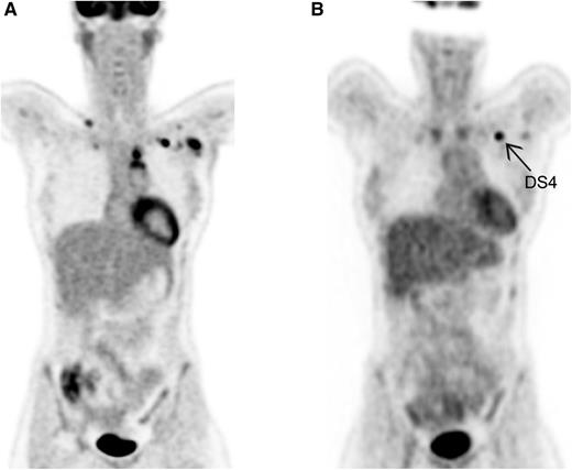 Visual assessment by DS. (A) Baseline PET in HL. Ann Arbor stage II. (B) Interim PET in HL. Partial metabolic response; left infraclavicular lymph node DS4.