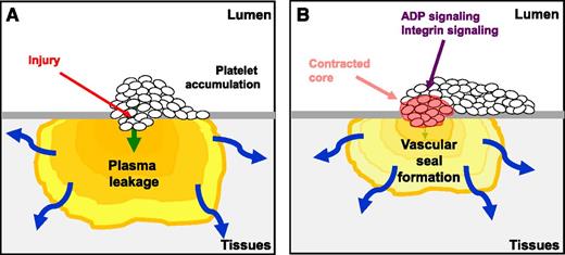 The accumulation of platelets at the site of penetrating vascular injury forms a seal to prevent the loss of plasma proteins. (A) The initial recruitment of platelets stems the loss of blood cells and begins to reduce plasma leakage. (B) The prevention of vascular leakage is enhanced by intrathrombus remodeling through ADP and integrin αIIbβ3 signaling resulting in formation of a contracted thrombus core. The figure has been adapted from Figure 7 in the article by Welsh et al that begins on page 1598.
