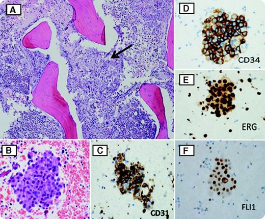 A previously healthy 49-year-old woman presented with a 2-month history of unintentional weight loss, early satiety, nausea, and vomiting. Whole-body computerized tomography scan revealed hepatosplenomegaly with enhancing lesions in the liver, spleen, lumbar vertebrae, and right iliac bone. A liver biopsy sample was initially interpreted as a hemangioma. Complete blood count revealed marked anemia with hemoglobin 7.8 g/dL, a white blood cell count of 25.4 × 109/L, and a platelet count of 135 × 109/L. Peripheral smear demonstrated a leukoerythroblastic picture. A left iliac bone marrow biopsy sample revealed a hypercellular marrow with osterosclerotic changes and focal involvement by neoplastic cells (panel A). Large sheets of abnormal, round to polygonal epithelioid cells, along with focal areas of irregularly anastomosing malignant vessel formation, were noted (panels A-B; arrow in panel A indicates sarcoma cells). By immunohistochemistry (IHC) studies, these tumor cells were strongly positive for CD31, CD34, Friend leukemia virus integration 1 (FLI1), and erythroblast transformation–specific related gene (ERG) stains (panels C-F) and negative for cytokeratin, CAM5.2, EMA, MOC31, CD3, CD20, CD30, CD138, MPO, S-100, BRST-2, HMB45, actin, desmin, CD117, factor 8, podoplanin, PAX-8, ALK-1, and DOG1 stains. / The patient was diagnosed with metastatic epithelioid angiosarcoma. Involvement of the bone marrow is an extremely rare presentation of this aggressive malignancy. Our case also demonstrates the utilization of the recently described, highly specific IHC markers such as ERG and FLI1 in identifying such rare neoplasms.