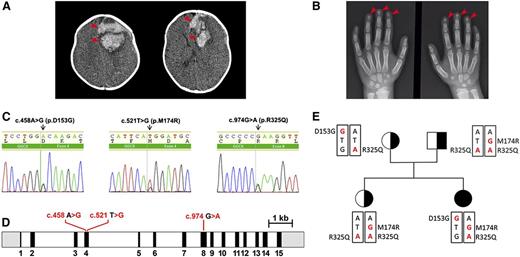 Figure 1. Radiologic images of clinical phenotypes, sequencing results of GGCX genotypes, and pedigrees of the patient. (A) Computed tomography brain scan at hospital admission, showing a large area of bleeding on the left frontal lobe (arrowheads) and deviation of the midline. (B) Hand x-ray showing short distal phalanges of the fingers (arrowheads), a characteristic of Keutel syndrome. (C) Chromatograms of the identified sequence variations demonstrating heterozygous mutations in GGCX at c.458 A>G, c.521 T>G, and C.974 G>A. (D) The intron-exon organization of GGCX with the location of the mutations as identified in the patient. The 5′ and 3′ untranslated regions are shown in grayscale, the exons are indicated by black rectangles, and the introns are represented by clear rectangles. (E) The pedigrees of the patient’s family. Squares, male; circles, females; black-filled circle, disease-affected patient; black half-filled square/circles, carrier. Mutated nucleotides are in red; mutated amino acid residues are indicated on the side.