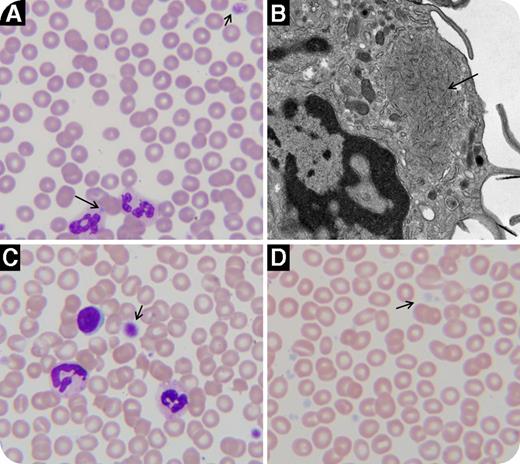 A 71-year-old male presented with a 20-year history of chronic kidney disease (stage 4) of unclear etiology. Several siblings had renal dysfunction and one had undergone renal transplantation. He had a history of bilateral cataracts and progressive sensorineural hearing loss. Thrombocytopenia was noticed but never evaluated because there was no abnormal bleeding. Laboratory studies demonstrated a platelet count of 50 × 109/L with mean platelet volume of 15.8 fL (7.6-10.8 fL). Large platelets with normal granularity and neutrophil cytoplasmic inclusions (panel A) were seen on peripheral blood smear. Buffy coat transmission electron microscopy confirmed the inclusions (panel B). The findings were compatible with myosin heavy chain-9 (MYH-9) nonmuscle-related disorder (Fechtner syndrome). Next-generation sequencing identified a previously described MYH-9 heterozygous c.4679T>G;p.Val1560Gly mutation. / The MYH-9–related disorders are characterized by macrothrombocytopenia, which can be associated with renal disease and hearing loss (Epstein syndrome) and cataracts (Fechtner syndrome). Whereas neutrophilic cytoplasmic inclusions are pathognomonic, they are not always present. Light microscopy is a simple and valuable tool that can be used in the evaluation of patients with suspected congenital thrombocytopenia. Macrothrombocytopenia with normal platelet granularity is also seen in Bernard–Soulier syndrome (panel C), whereas gray platelet syndrome (NBEAL2 mutations) has large but hypogranular platelets (panel D). Short arrows identify platelets, while long arrows identify neutrophilic cytoplasmic inclusions.