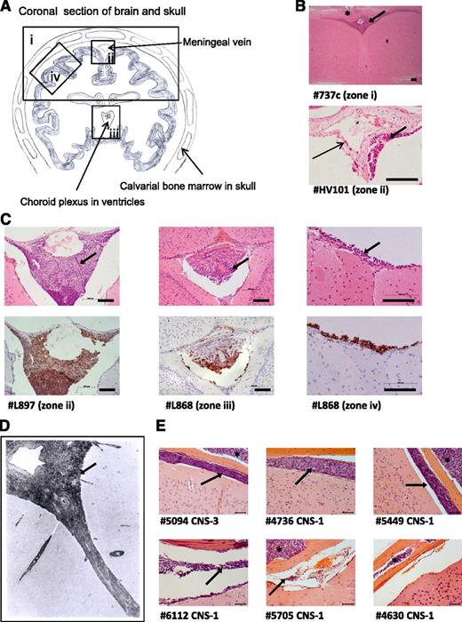 Figure 2. Histologic analysis of brains from xenografted mice. (A) Line drawing of a coronal section of murine brain showing approximate locations (zones i-iv) of images shown in panels B-D. (B) Photomicrographs of hematoxylin and eosin (H&E)-stained brain sections. Top: low-power view of cerebral cortex and leptomeninges (original magnification ×5); bottom: close-up of a central meningeal vessel (original magnification ×40). Long thin arrow indicates leukemic cells in the vessel wall. Bar represents 100 μm. (C) H&E (top) and corresponding anti-human CD45 (bottom) staining of leukemic deposits. Left: Cells surrounding the dural venous sinus (original magnification ×20); center: cells within choroid plexus (original magnification ×20); right: high-power view of meninges (original magnification ×40). Bar represents 100 μm. (D) Postmortem image of grade 2 arachnoid leukemia (zone ii) in a child with ALL (H&E, original magnification ×33), reproduced with permission from Price and Johnson.4 (E) Representative coronal sections (all zone iv) from mice engrafted with a CNS-3 sample and 5 matched CNS-1 controls (H&E, original magnification ×40). Bar represents 50 μm. Thick arrows (panels B-E) mark the leukemic infiltrate within the leptomeninges and asterisks (panels B and E) mark leukemic infiltrates within the calvarial BM cavity. Numbers preceded by the # symbol (panels B, C, and E) denote the sample identifiers in Table 1.