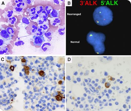 A 2-year-old boy presented with persistent fever and massive hepatosplenomegaly. Complete blood count revealed marked leukocytosis (white blood cells, 102 000/μL), anemia (hemoglobin, 5.8 g/dL), and thrombocytopenia (platelets, 59 000/μL). Peripheral blood (PB) smear showed marked neutrophilia with toxic granulation and vacuolation, few variably sized atypical cells with round or irregular nuclei and basophilic vacuolated cytoplasm, and no blasts (panel A). Serum ferritin and soluble interleukin 2 receptor were elevated (1091 ng/mL and 162 090 units/mL, respectively). Bone marrow (BM) showed granulocytic hyperplasia with few atypical cells (same as those seen in PB). Fluorescence in situ hybridization (FISH) analysis showed ALK gene rearrangement in 7% of BM nuclei and in 5.6% of PB nuclei (panel B). Immunostain on the BM clot section showed few CD30+ and ALK-1+ cells (panels C-D). Anaplastic large-cell lymphoma (ALCL) and secondary hemophagocytic lymphohistiocytosis (HLH) were diagnosed. / ALCL is one of the most common pediatric large-cell lymphomas and occasionally shows leukemoid reaction, HLH, or leukemic involvement. Leukemoid reaction and/or HLH can mask the primary tumor. Routine flow cytometry study of the PB or BM may not identify the tumor cells due to “null cell” type and low leukemic involvement. CD30/ALK1 staining and FISH for the ALK gene are necessary to effectively identify the tumor cells and make the diagnosis in these cases.