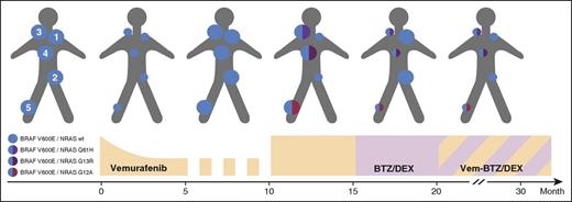 Figure 2. Schematic overview of the representative myeloma lesions in the course of treatment. The 5 representative lesions were located at the left shoulder above the acromial bone (lesion 1), the left iliac bone (2), the right clavicle (3), adjacent to the sternal bone (4), and the right proximal tibia (5). Lesions 1, 3, and 5 were extramedullary tumors; lesions 2 and 4 were intramedullary computed tomography-guided biopsies. Bullet sizes depict growth and regression, respectively.