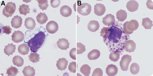 This peripheral blood is from a 3-month-old male patient with a prior diagnosis of GM1 gangliosidosis type I, who was admitted with fever and leukocytosis. There is a family history of 2 siblings with GM1 gangliosidosis. Cellulitis was diagnosed and successfully treated with antibiotics. This photomicrograph depicts the typical peripheral blood findings in GM1 gangliosidosis: a vacuolated lymphocyte (panel A) and an eosinophil with enlarged and sparse granules (panel B). Large, sharply defined vacuoles in mature lymphocytes may suggest any of several lysosomal storage diseases. The additional finding of the abnormal eosinophilic granulation is characteristic of GM1 gangliosidosis specifically. / GM1 gangliosidosis is an autosomal recessive lysosomal storage disorder caused by mutations in the GLB1 gene, which codes for β-galactosidase. The incidence is estimated to be between 1 in 100 000 to 200 000 live births. Type I is the most severe form and results in neurologic impairment caused by accumulation of GM1 gangliosides, typically within the first 6 months of life. Other features include a macular cherry-red spot, coarse facies, and hepatosplenomegaly. Vacuolated lymphocytes and eosinophils with abnormally sparse and enlarged granules are characteristic findings in the peripheral smear. Supportive care is typically given, because there is no effective treatment of the underlying disorder.