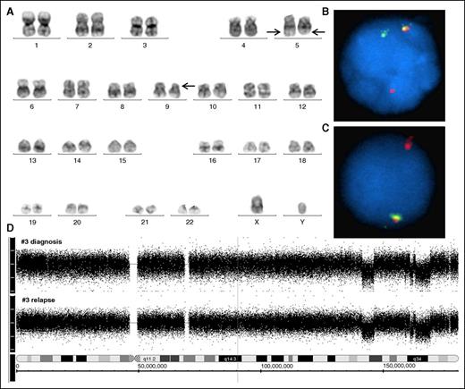 Figure 1. Cytogenetics, FISH, and SNP 6.0 profile of EBF1-PDGFRB–positive patients. (A) Karyogram from the diagnostic bone marrow of patient 6 showing that both copies of chromosome 5 are abnormal, suggesting the presence of balanced translocation t(5;5)(q33.1;q33.3) (lower arrows). The karyogram also shows a deletion of the short arm of chromosome 9 (upper arrow). (B) FISH using the EBF1 break-apart probe (described in supplemental Figure 3B) showing a balanced rearrangement (patient 6) and (C) showing an unbalanced rearrangement consistent with the 5q33 deletion (patient 7). (D) SNP 6.0 profile of chromosome 5 in patient 3, showing a series of deletions along the long arm of chromosome 5 consistent with complex rearrangements, such as chromothripsis. This profile was conserved between diagnosis and relapse.