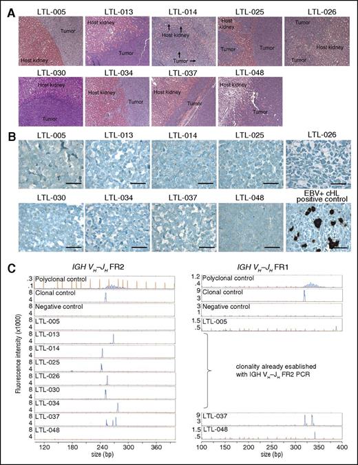 Figure 1. Establishment of 9 LBCL PDX models. (A) Hematoxylin and eosin stains of 9 LBCL PDX models propagated under the renal capsule of NSG mice. Original magnification ×200. (B) Epstein-Barr-encoded RNA in situ hybridization of all 9 LBCL PDX models. An EBV-positive classical Hodgkin lymphoma (cHL) served as positive control. Bars represent 100 μm. (C) Clonality of the 9 PDX models assessed and interpreted according to the EuroClonality/BIOMED-2 guidelines.45 An IgH VH-JH spanning PCR (FR2, left) was performed on all 9 LBCL PDX models. Tumors without a clonal peak (LTL-005, LTL-037, and LTL-048) or an inconclusive result (LTL-037) were sequentially analyzed with a second PCR (FR1, right). Genomic DNA (gDNA) of NSG mouse tail served as a negative control, gDNA of peripheral blood mononuclear cells from a healthy human volunteer served as a polyclonal control, and gDNA of the Burkitt lymphoma cell line (BL30) served as a monoclonal control. EBV, Epstein-Barr virus; FR, fragment; PCR, polymerase chain reaction.