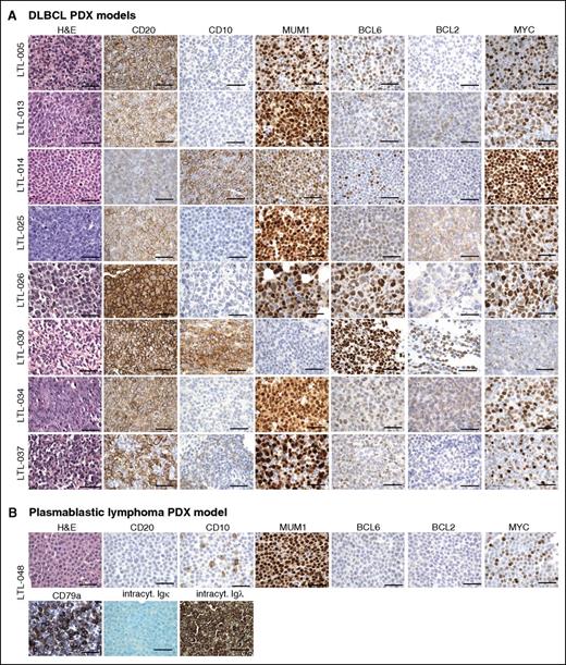 Figure 2. IHC characterization of all 9 PDX models. (A) IHC analyses of the indicated markers in all 8 DLBCL PDX models, which were consistent with the diagnosis of DLBCL. (B) IHC assessment of indicated markers in PDX model LTL-048, which is consistent with the diagnosis of PBL. Scale bars, 100 μm. See also Table 1. intracyt., intracytoplasmic.